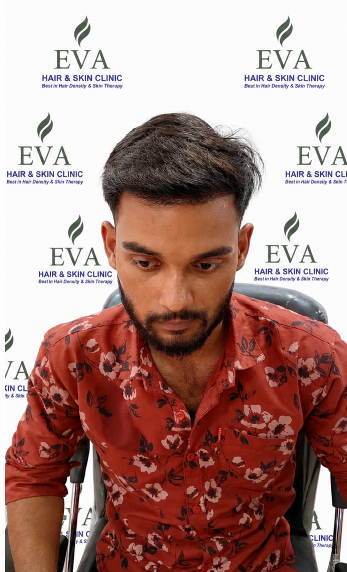 After hair transplant result 5